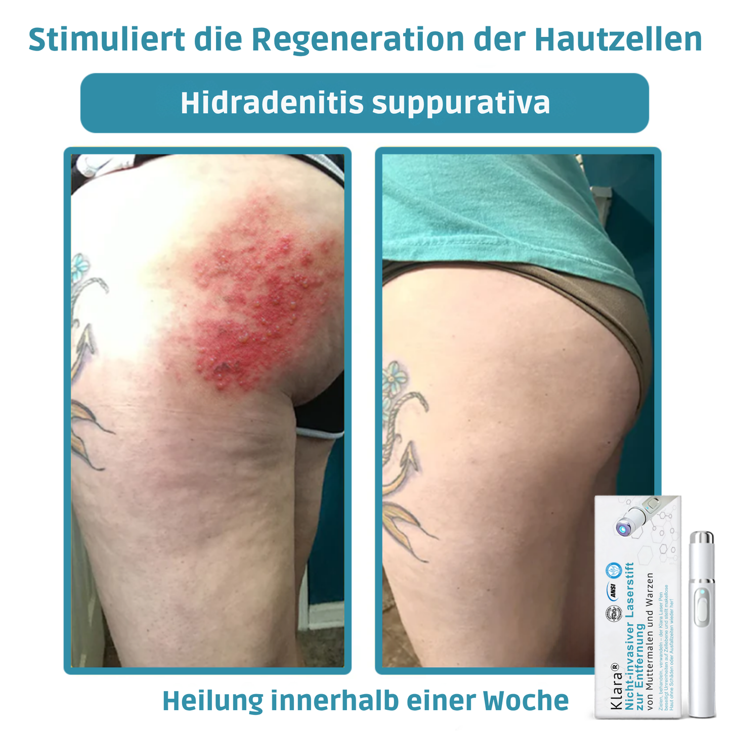 RadiantGlow™ Pain-Free Laser Pen – Reveal Flawless Skin Anytime