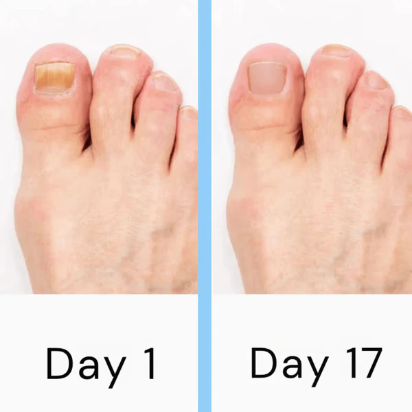Nail Fungus Treatment Device with Laser Technology