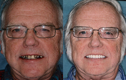 Transformative Custom Full Denture Set - Limited Time Offer!