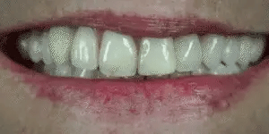 Snap-On Veneers for Upper and Lower Teeth – Quick Natural Smile Solution