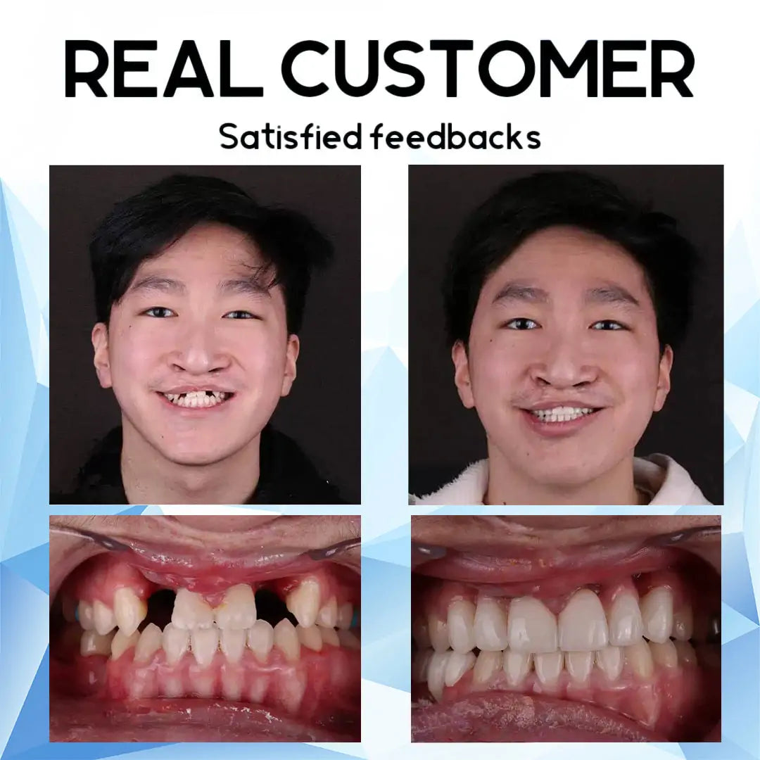 SmileMend™ – Custom Silicone Denture Solution for a Perfect Smile