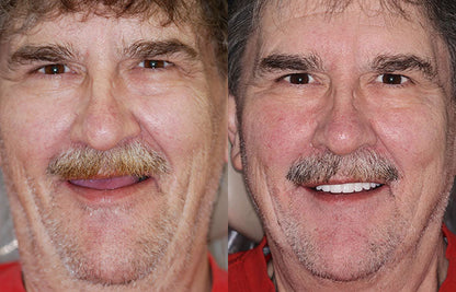 Transformative Custom Full Denture Set - Limited Time Offer!