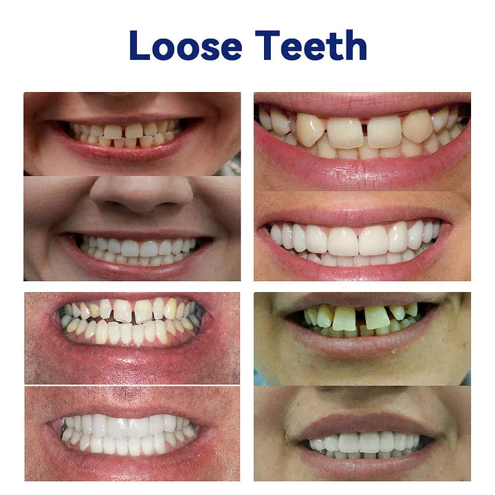 FlexiSmile Complete Denture System for Enhanced Comfort