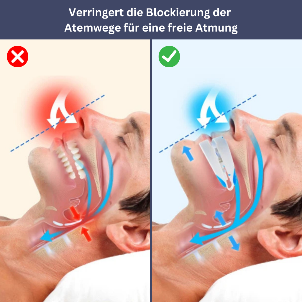 Silent Nights: Advanced Snoring Relief Device