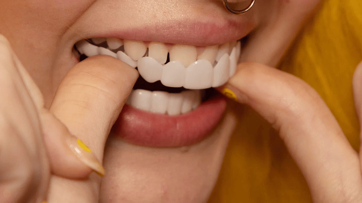 Snap-On Dental Veneers for Upper and Lower Teeth