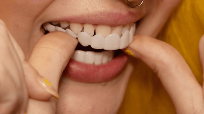 Snap-On Dental Veneers for Upper and Lower Teeth