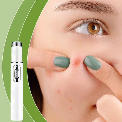 Pain-Free Acne Removal for Smooth, Clear Skin
