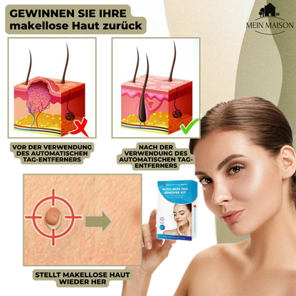 SkinClear Wart and Mole Remover | Gentle and Effective | For Face and Body
