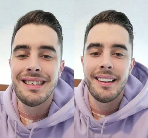 Smile Veneers for Upper and Lower Jaw – Complete Set