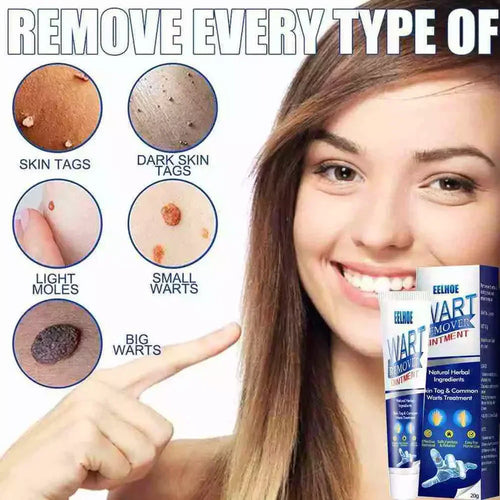 Wart Removal Cream – Fast and Efficient Treatment