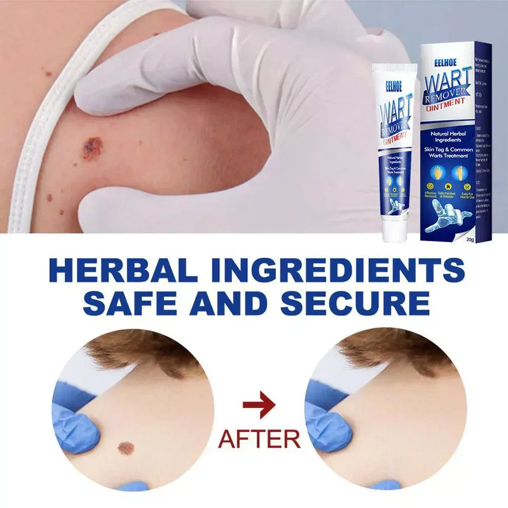 Wart Removal Cream – Fast and Efficient Treatment