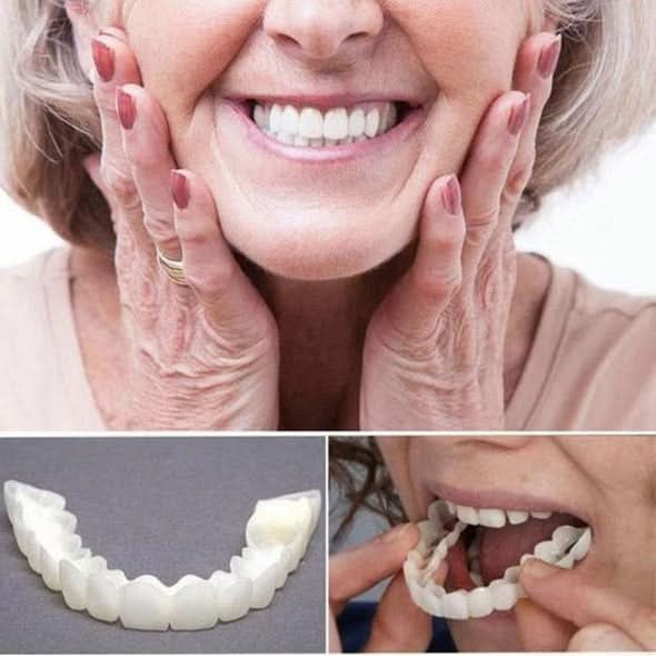 Upper and Lower Smile Veneer Kit