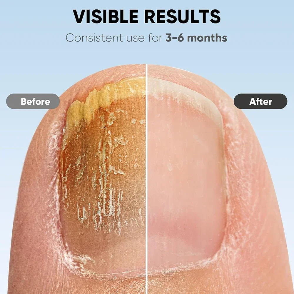 Restore Clear, Healthy Nails in Just 7 Minutes Daily