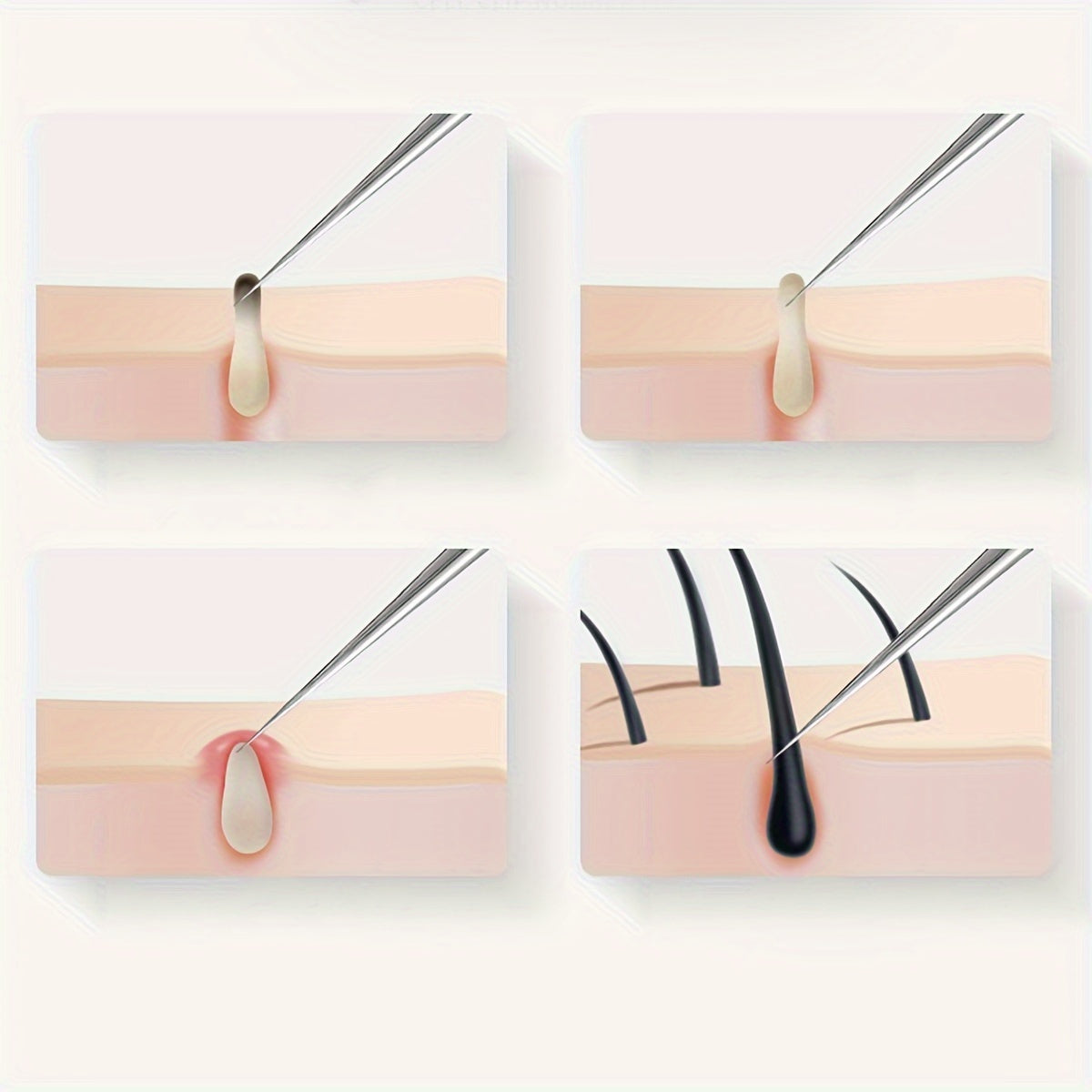 PureGlow Extractor - Premium Stainless Steel Blemish Tool