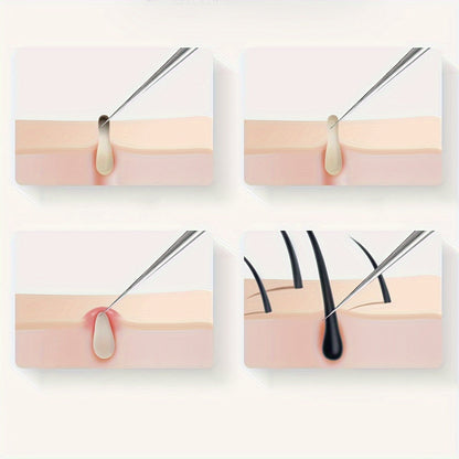 PureGlow Extractor - Premium Stainless Steel Blemish Tool