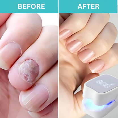 Restore Healthy Nails with FungiGuard™ – 50% Off Today!
