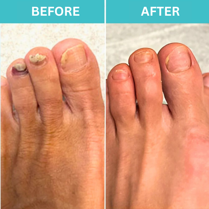 Restore Healthy Nails with FungiGuard™ – 50% Off Today!