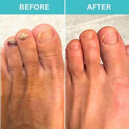 Restore Healthy Nails with FungiGuard™ – 50% Off Today!
