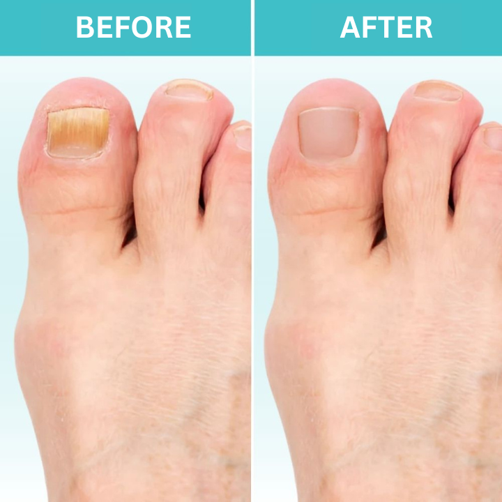 Restore Healthy Nails with FungiGuard™ – 50% Off Today!
