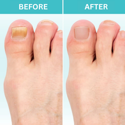 Restore Healthy Nails with FungiGuard™ – 50% Off Today!