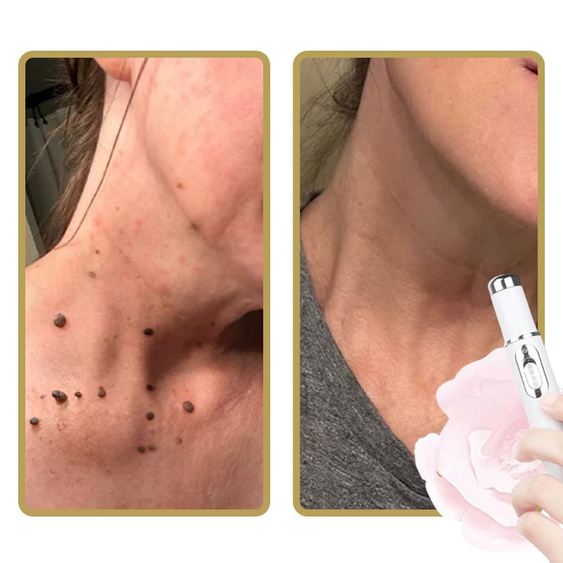 Pain-Free Acne Removal for Smooth, Clear Skin