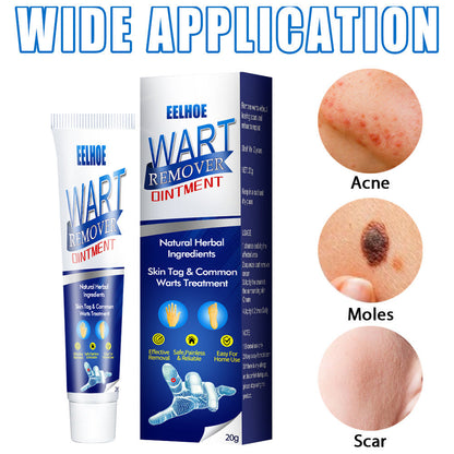Wart Removal Cream – Fast and Efficient Treatment