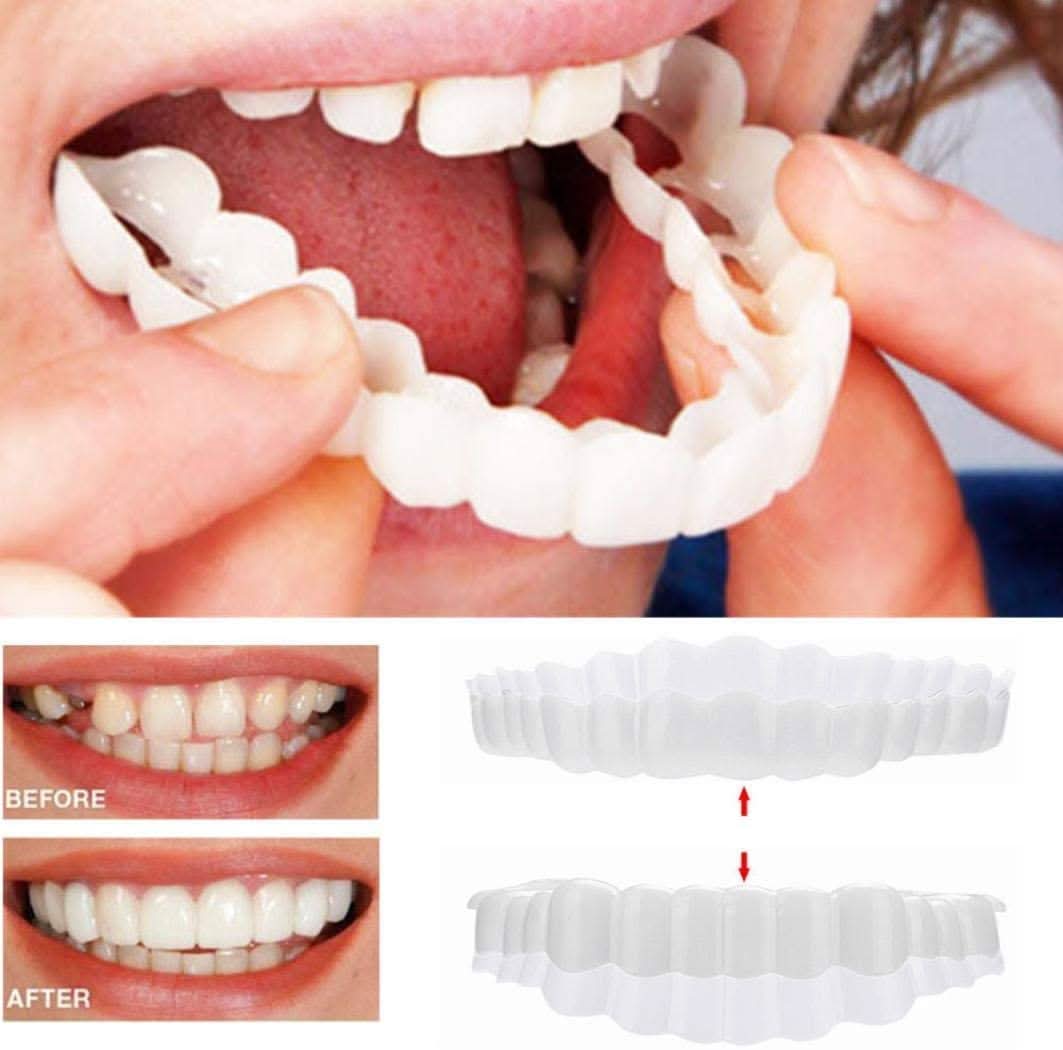 Upper and Lower Smile Veneer Kit