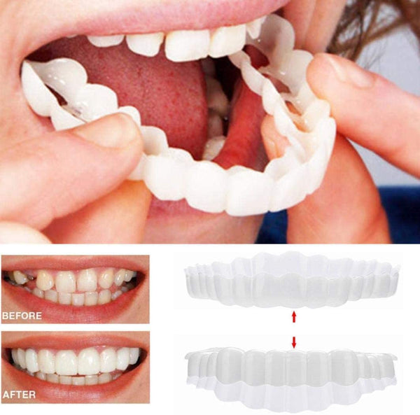 Smile Veneers for Upper and Lower Jaw – Complete Set