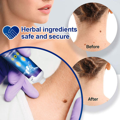 Wart Removal Face Cream