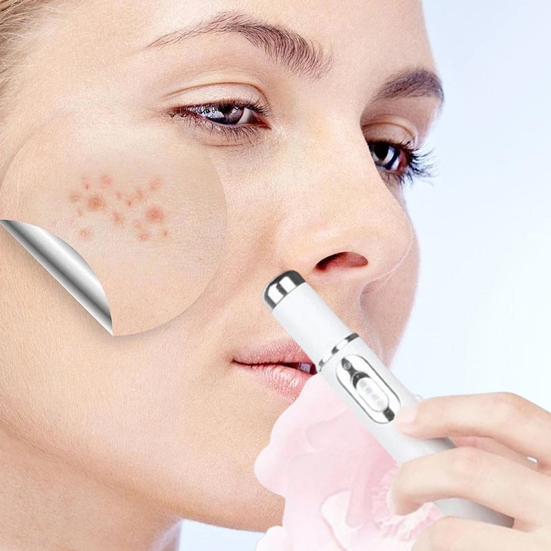 Pain-Free Acne Removal for Smooth, Clear Skin