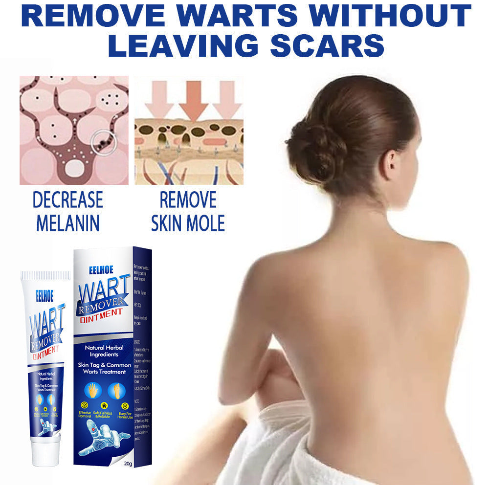 Wart Removal Cream – Fast and Efficient Treatment