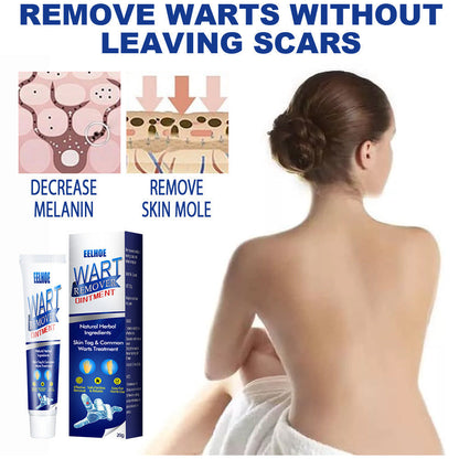 Wart Removal Cream – Fast and Efficient Treatment