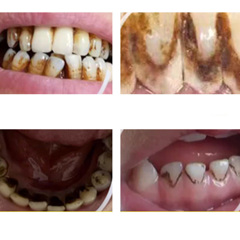 Instant Stain Remover for Teeth – Achieve a Bright Smile