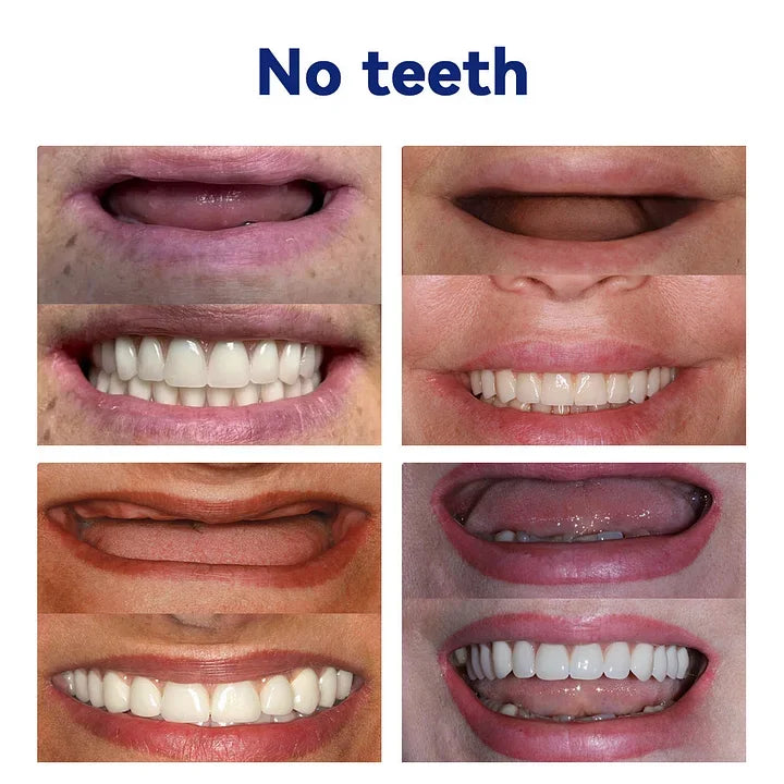 FlexiSmile Complete Denture System for Enhanced Comfort
