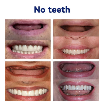 FlexiSmile Complete Denture System for Enhanced Comfort