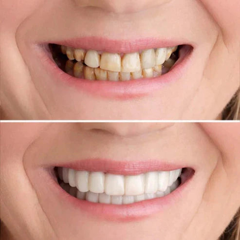 Instant Smile Enhancer Kit | Achieve a Brighter Smile in Minutes | Reusable & Gentle on Teeth | 1 Complete Set in Bright White