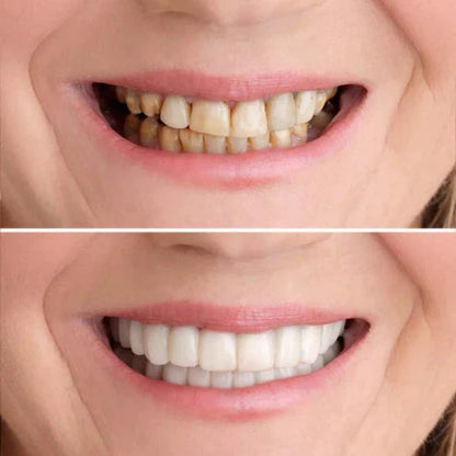 Instant Smile Enhancer Kit | Achieve a Brighter Smile in Minutes | Reusable & Gentle on Teeth | 1 Complete Set in Bright White