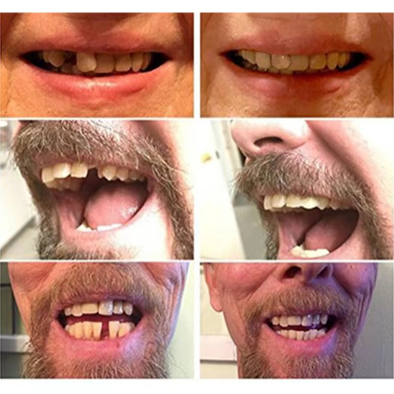 Durable Artificial Teeth for Natural Smiles