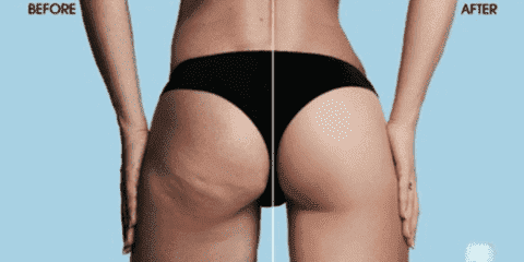 Silicone Cups for Vacuum Therapy to Reduce Cellulite
