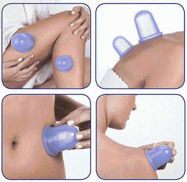 Silicone Cups for Vacuum Therapy to Reduce Cellulite
