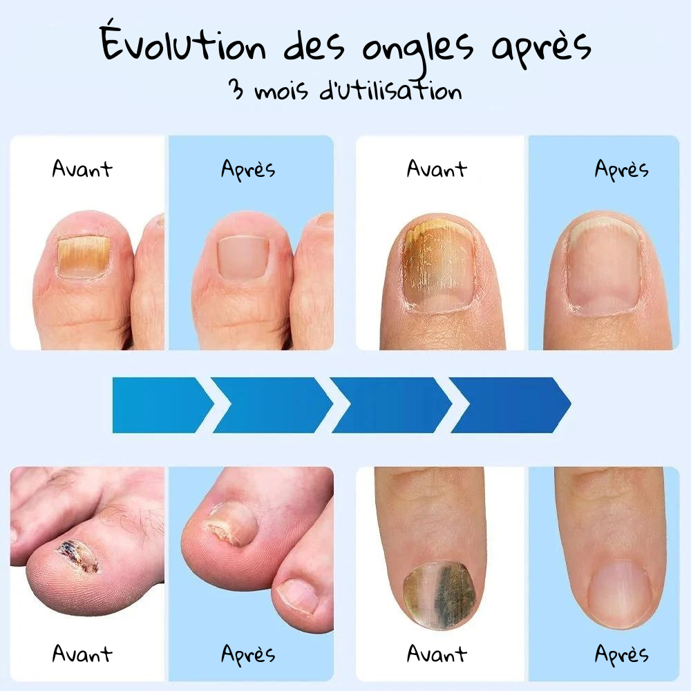 Home Nail Restoration Laser System