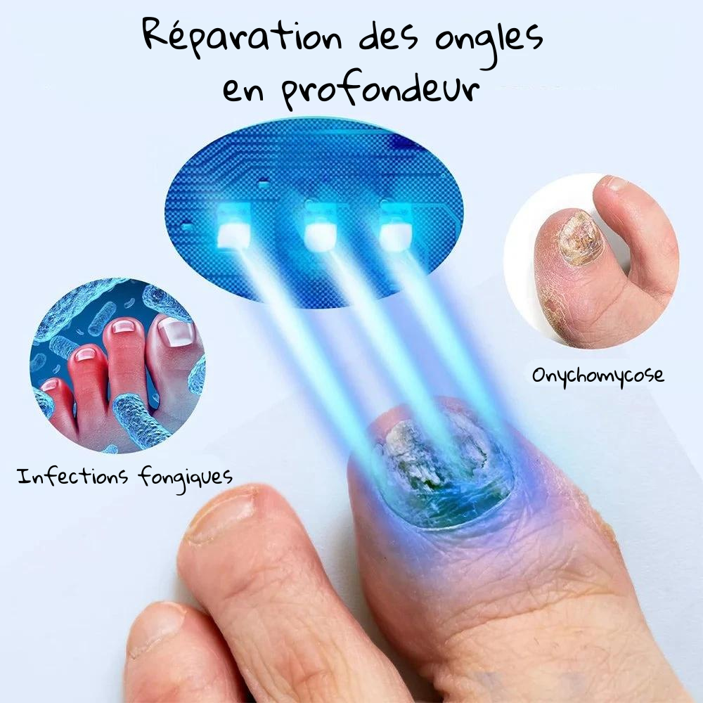 Home Nail Restoration Laser System