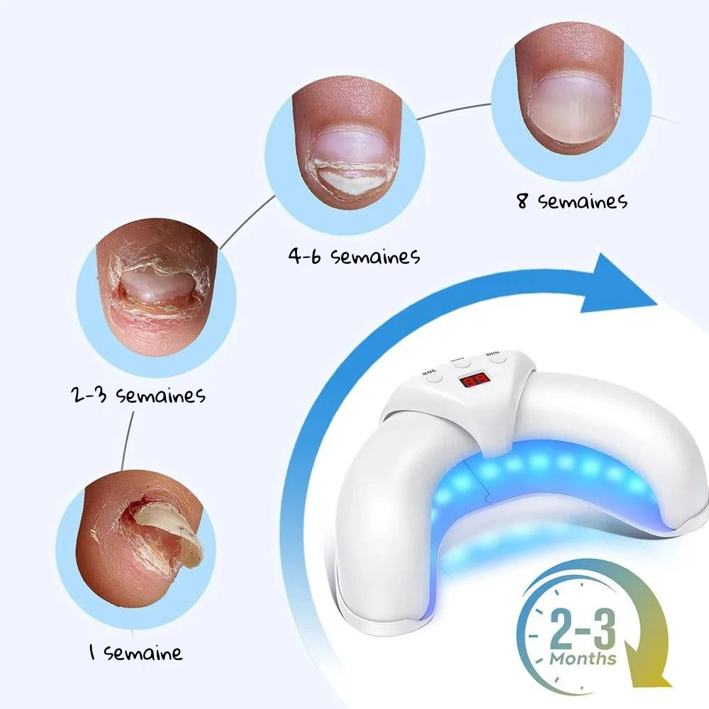Home Nail Restoration Laser System