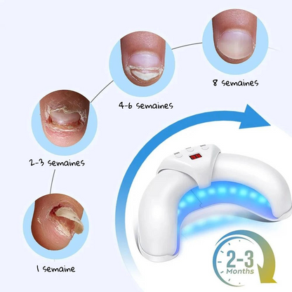 Home Nail Restoration Laser System