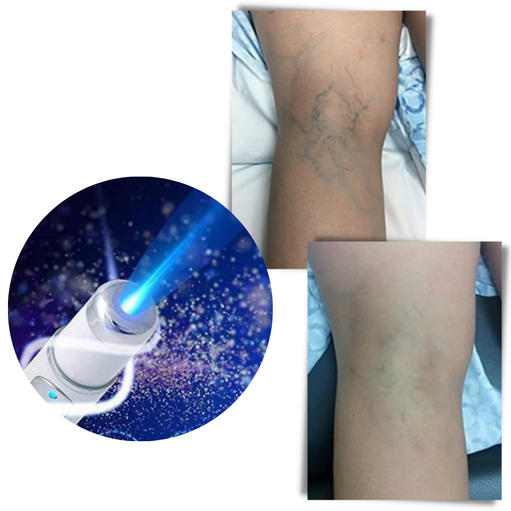 Blue Light Skin Therapy Device