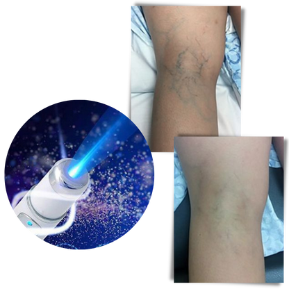 Blue Light Skin Therapy Device