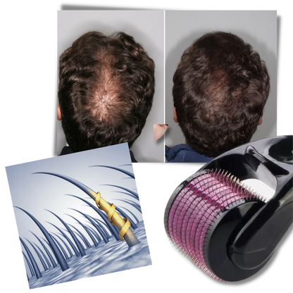 Hair and Beard Growth Derma Roller