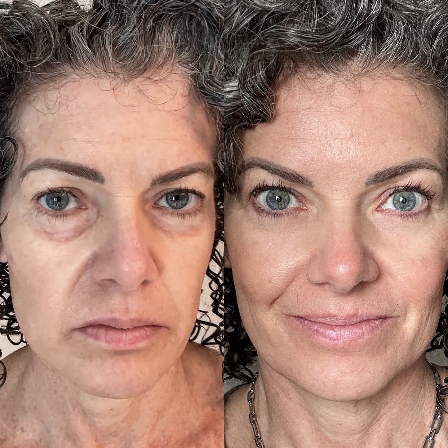 RevitalEyes | Brighten and Lift Your Under-Eyes in 2 Weeks!