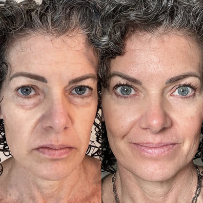 RevitalEyes | Brighten and Lift Your Under-Eyes in 2 Weeks!