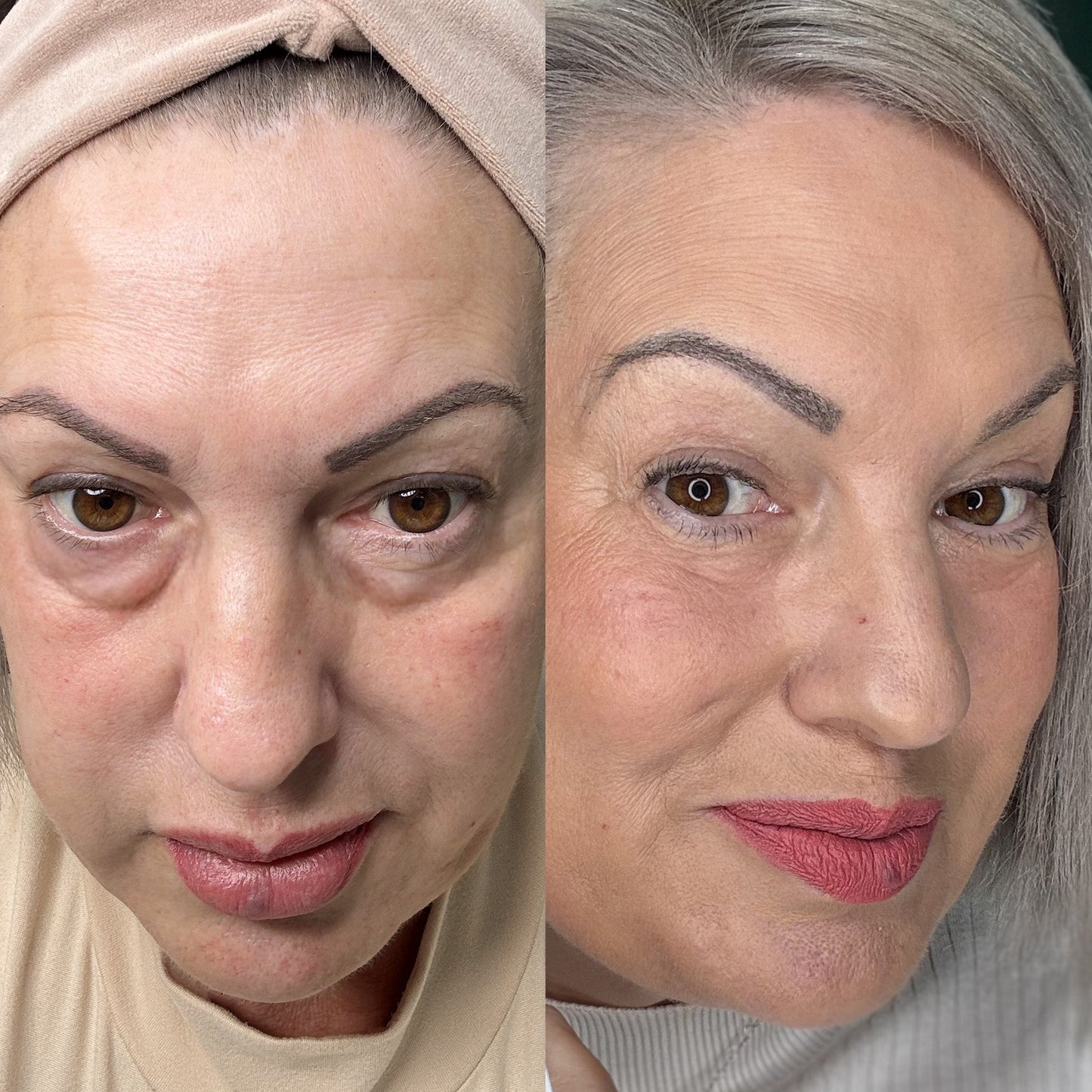 RevitalEyes | Brighten and Lift Your Under-Eyes in 2 Weeks!
